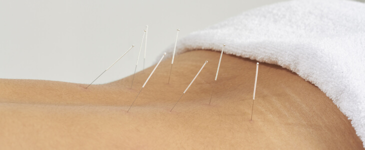 Close up of acupuncture needles in a woman's low back