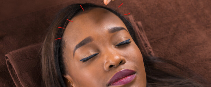 Young African Woman Getting Acupuncture Treatment for Migraines